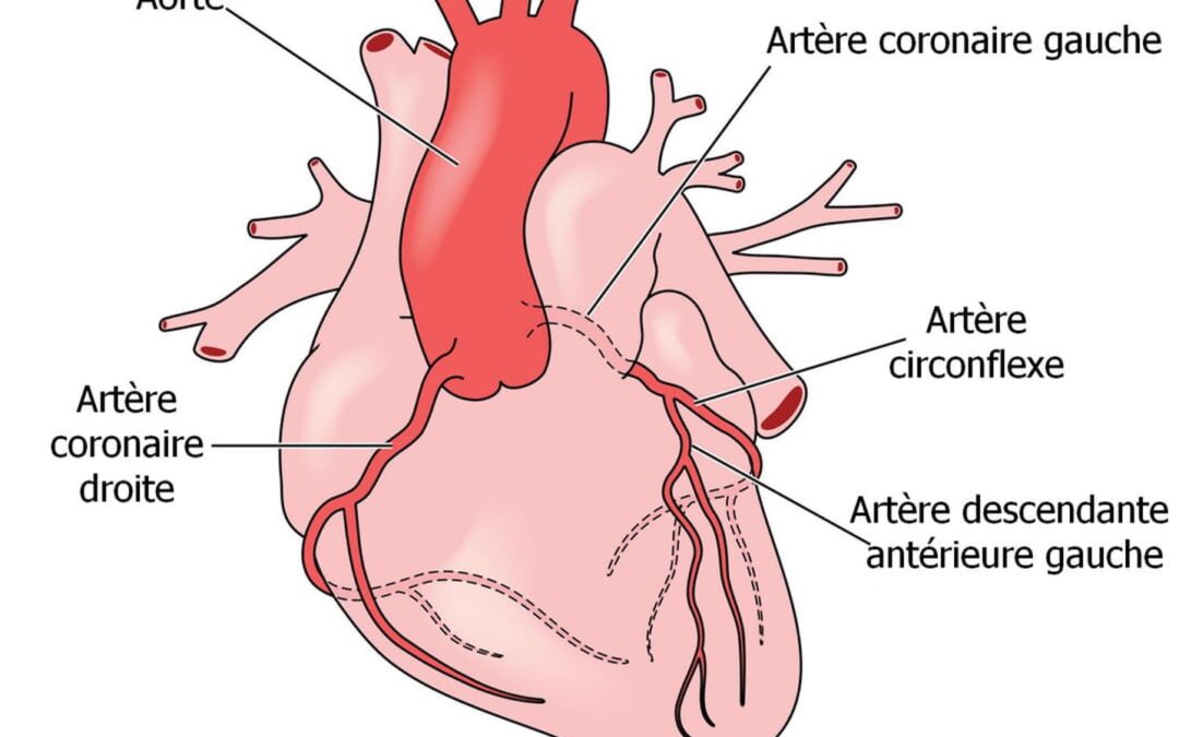 Tout savoir sur l’Infarctus du myocarde atypique.